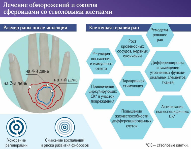 Холод, но: обморожения и ожоги будут лечить без шрамов и рубцов